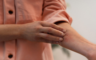 5 Fakta Mengenai Virus Campak dan Tindakan yang Harus Dilakukan untuk Pencegahan Penyebaran